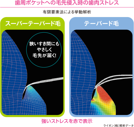 歯周ポケットへの毛先侵入時の歯肉ストレス